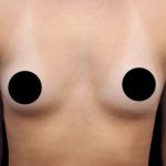 Breast Augmentation Before & After Patient #422