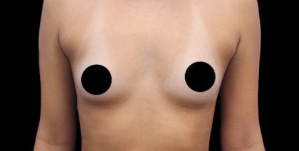 Breast Augmentation Before & After Patient #422