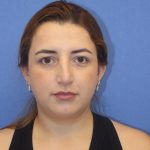 Primary Rhinoplasty Before & After Patient #776
