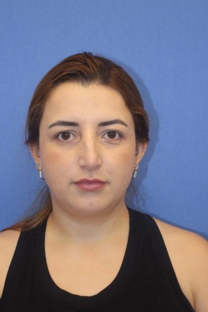 Primary Rhinoplasty Before & After Patient #776