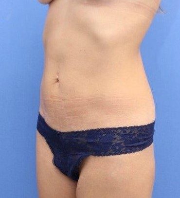 Liposuction/Liposculpture Before & After Patient #597