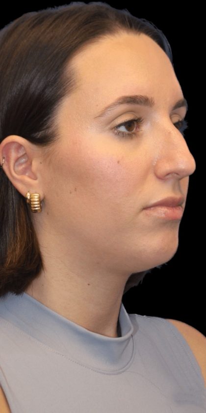 Primary Rhinoplasty Before & After Patient #805