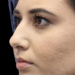 Primary Rhinoplasty Before & After Patient #808
