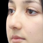 Primary Rhinoplasty Before & After Patient #809