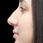 Primary Rhinoplasty Before & After Patient #822