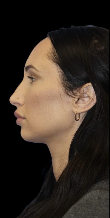 Primary Rhinoplasty Before & After Patient #824