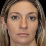 Primary Rhinoplasty Before & After Patient #825