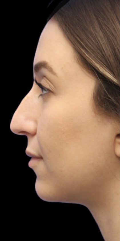 Primary Rhinoplasty Before & After Patient #855