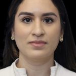Primary Rhinoplasty Before & After Patient #856