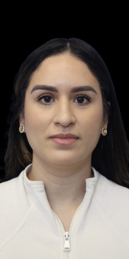Primary Rhinoplasty Before & After Patient #856