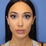 Revision Rhinoplasty Before & After Patient #875