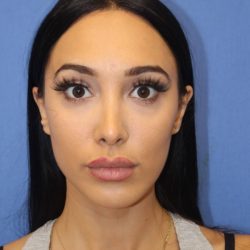 Revision Rhinoplasty Before & After Patient #875