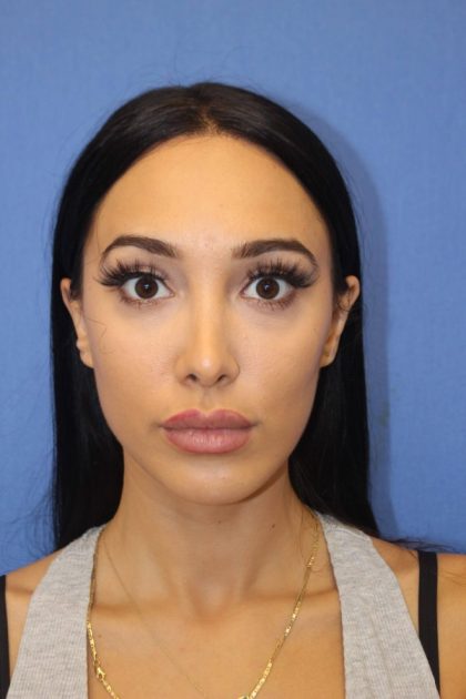 Revision Rhinoplasty Before & After Patient #875