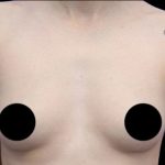 Breast Augmentation Before & After Patient #494