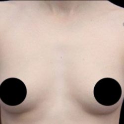 Breast Augmentation Before & After Patient #494