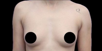 Breast Augmentation Before & After Patient #494