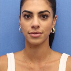Revision Rhinoplasty Before & After Patient #876