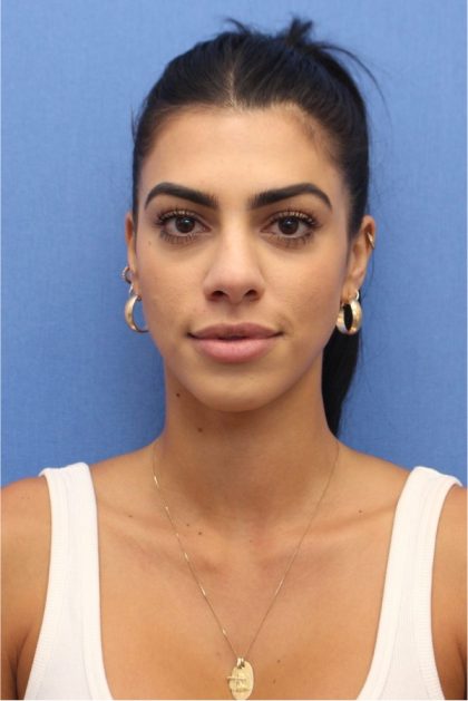 Revision Rhinoplasty Before & After Patient #876
