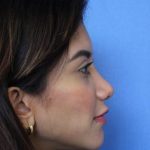 Primary Rhinoplasty Before & After Patient #744