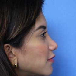 Primary Rhinoplasty Before & After Patient #744