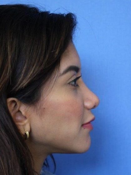 Primary Rhinoplasty Before & After Patient #744