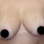 Breast Lift Before & After Patient #538