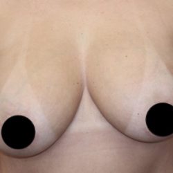 Breast Lift Before & After Patient #538