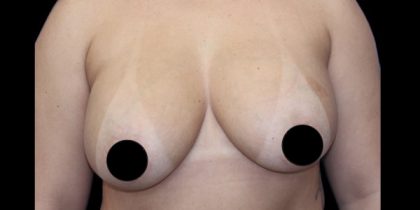 Breast Lift Before & After Patient #538