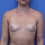 Breast Augmentation Before & After Patient #420