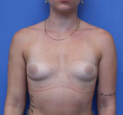 Breast Augmentation Before & After Patient #420