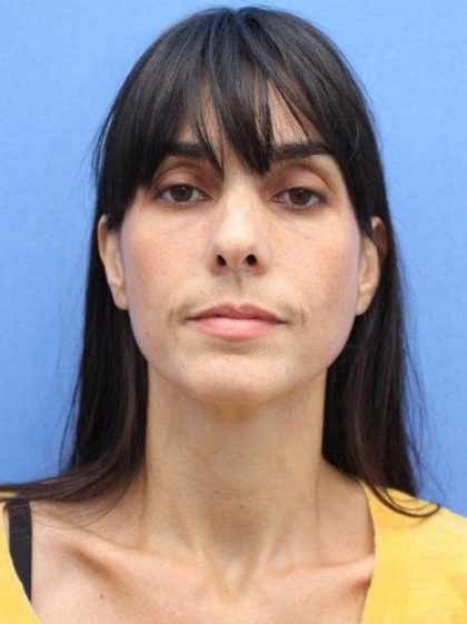 Primary Rhinoplasty Before & After Patient #777