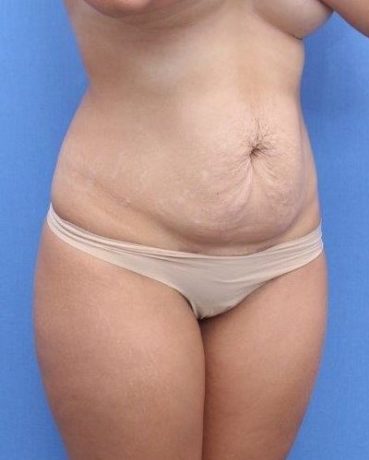 Tummy Tuck Before & After Patient #892