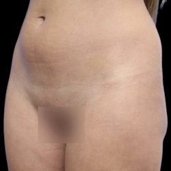 Liposuction/Liposculpture Before & After Patient #604