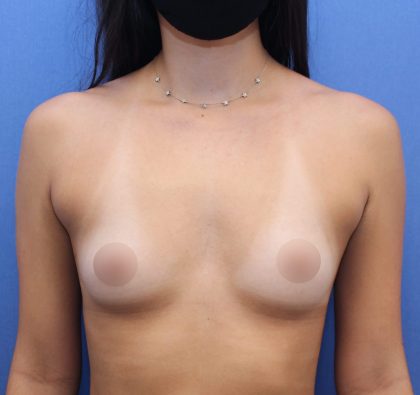 Breast Augmentation Before & After Patient #421