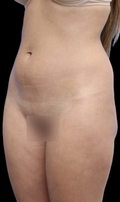 Liposuction/Liposculpture Before & After Patient #604