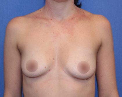 Breast Augmentation Before & After Patient #419