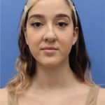 Primary Rhinoplasty Before & After Patient #740