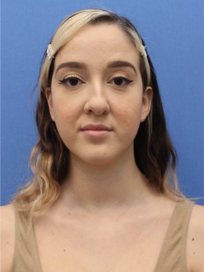 Primary Rhinoplasty Before & After Patient #740