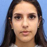 Primary Rhinoplasty Before & After Patient #741