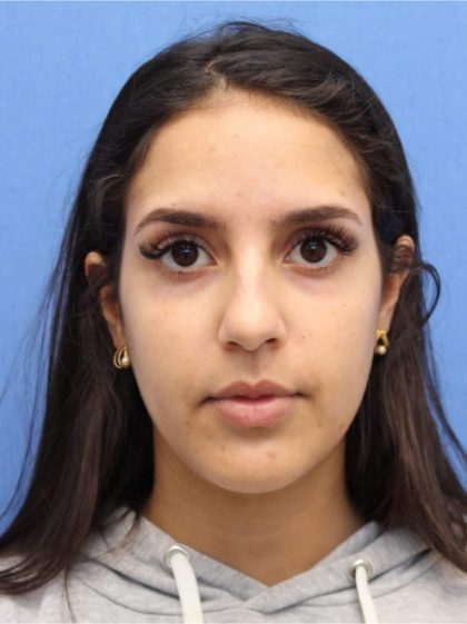 Primary Rhinoplasty Before & After Patient #741