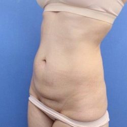 Liposuction/Liposculpture Before & After Patient #594