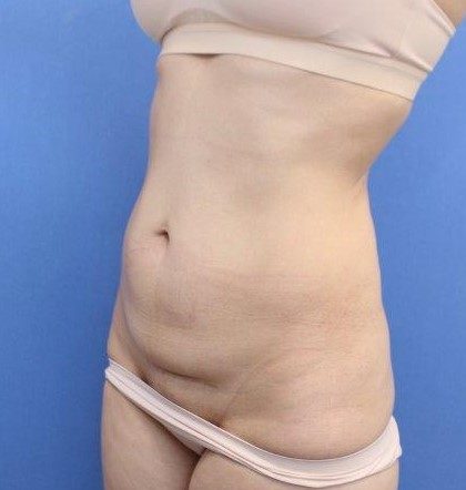 Liposuction/Liposculpture Before & After Patient #594