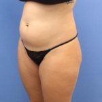 Liposuction/Liposculpture Before & After Patient #595