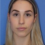Primary Rhinoplasty Before & After Patient #743