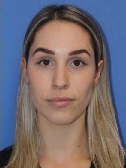 Primary Rhinoplasty Before & After Patient #743
