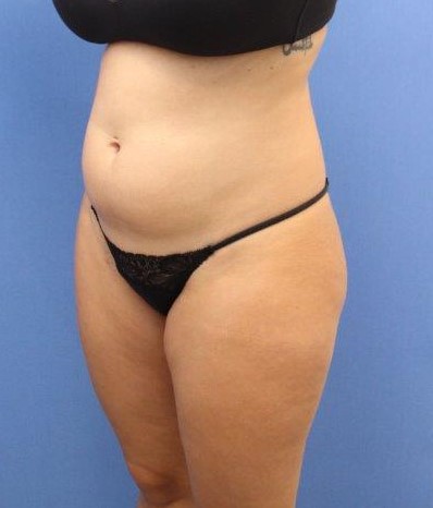 Liposuction/Liposculpture Before & After Patient #595