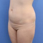 Liposuction/Liposculpture Before & After Patient #596