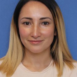 Primary Rhinoplasty Before & After Patient #775
