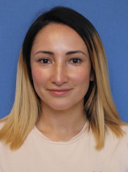 Primary Rhinoplasty Before & After Patient #775