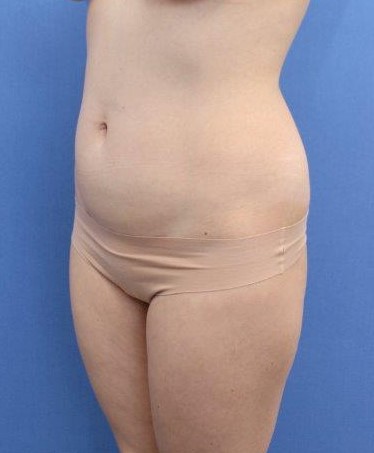 Liposuction/Liposculpture Before & After Patient #596